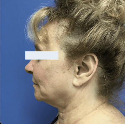 Facelift Before & After Patient #1775