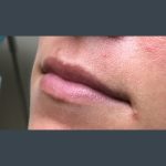 Injection Before & After Patient #1000