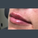 Injection Before & After Patient #1000