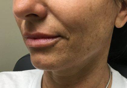 Injection Before & After Patient #1003