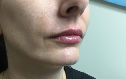 Injection Before & After Patient #1018