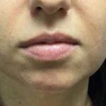 Injection Before & After Patient #1033