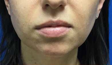 Injection Before & After Patient #1033