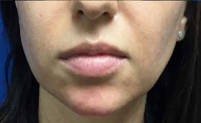 Injection Before & After Patient #1033