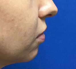 Injection Before & After Patient #1033