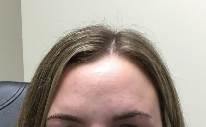 Injection Before & After Patient #1038