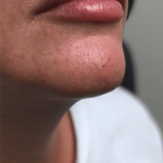Injection Before & After Patient #1043
