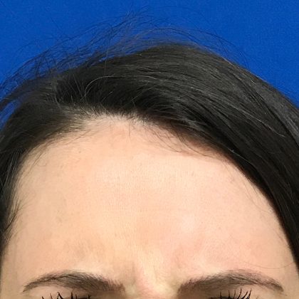 Injection Before & After Patient #1061