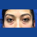 Injection Before & After Patient #1071