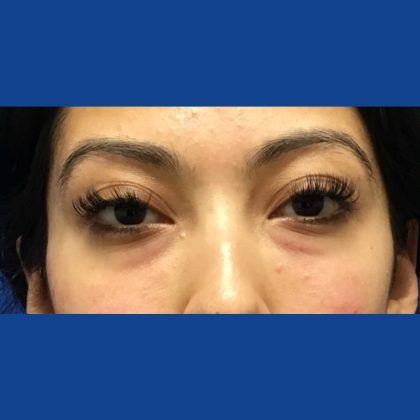 Injection Before & After Patient #1071