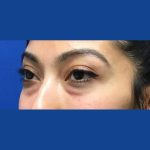 Injection Before & After Patient #1071