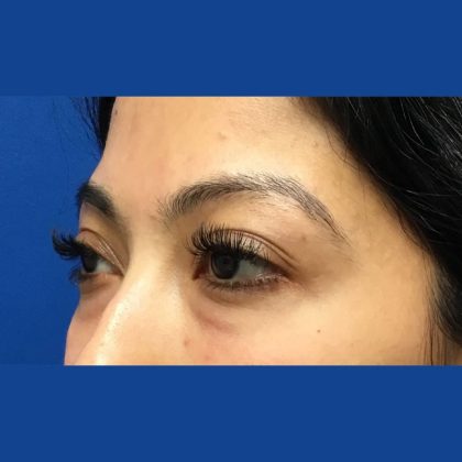 Injection Before & After Patient #1071