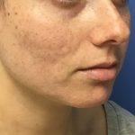 Injection Before & After Patient #1081
