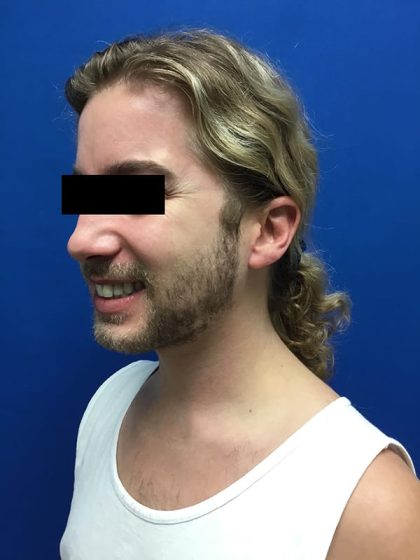 Injection Before & After Patient #1086