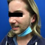 Injection Before & After Patient #1086