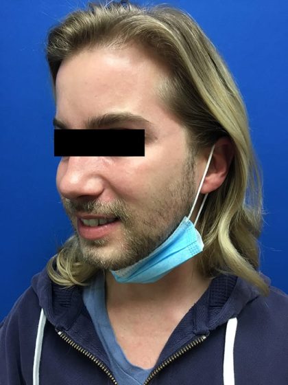 Injection Before & After Patient #1086