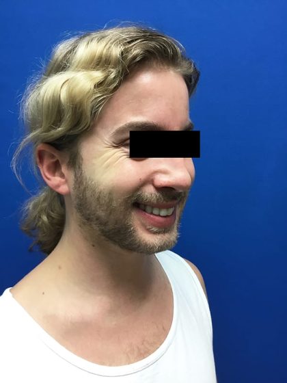 Injection Before & After Patient #1086