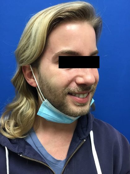 Injection Before & After Patient #1086