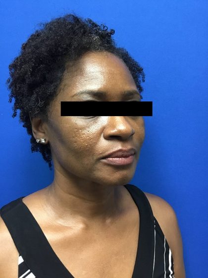 Injection Before & After Patient #1096