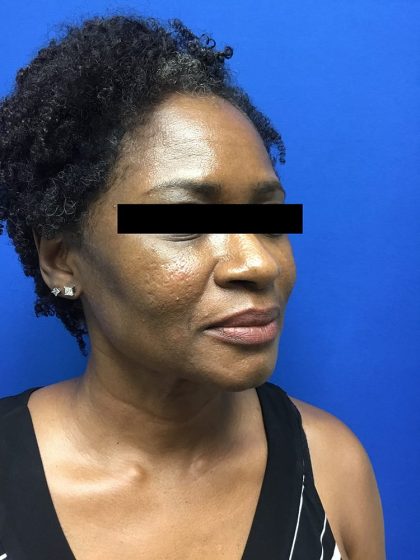 Injection Before & After Patient #1096