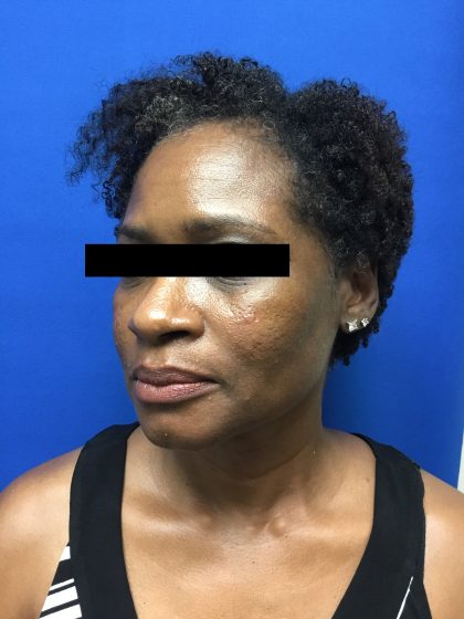 Injection Before & After Patient #1096