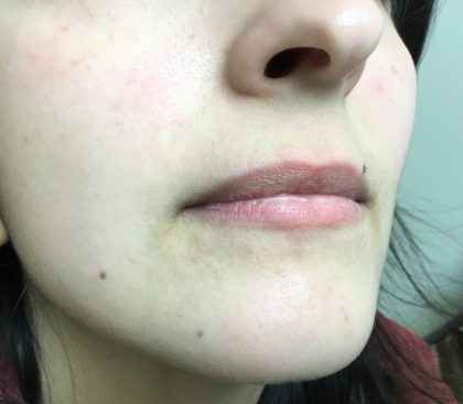 Injection Before & After Patient #1136