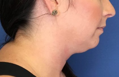 Injection Before & After Patient #1141