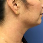 Injection Before & After Patient #1141