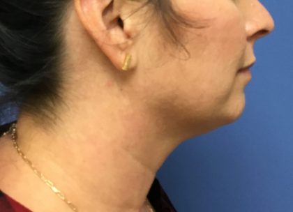 Injection Before & After Patient #1141
