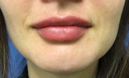 Injection Before & After Patient #1146