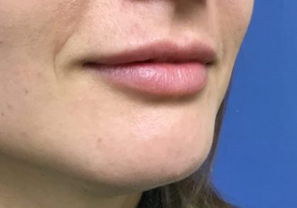 Injection Before & After Patient #1146