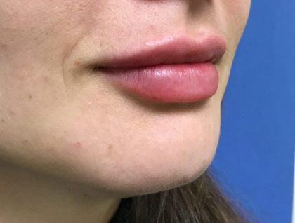 Injection Before & After Patient #1146