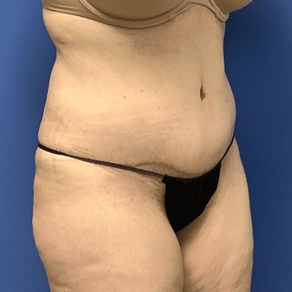 Liposuction Before & After Patient #2167