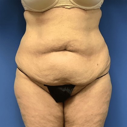 Liposuction Before & After Patient #2167
