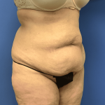 Liposuction Before & After Patient #2167