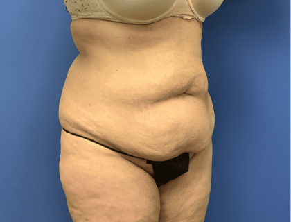 Liposuction Before & After Patient #2167