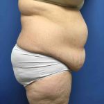 Liposuction Before & After Patient #2172