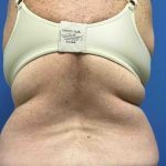 Liposuction Before & After Patient #2172