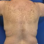 Liposuction Before & After Patient #2172