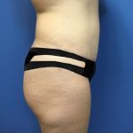Liposuction Before & After Patient #2179