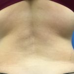 Liposuction Before & After Patient #2179