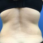 Liposuction Before & After Patient #2179
