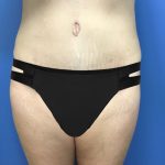 Liposuction Before & After Patient #2179