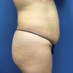 Liposuction Before & After Patient #2179