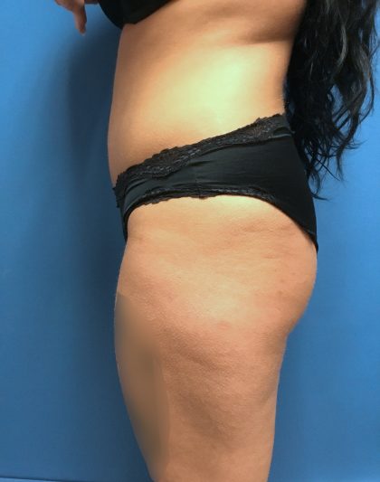Liposuction Before & After Patient #2191