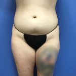 Liposuction Before & After Patient #2191