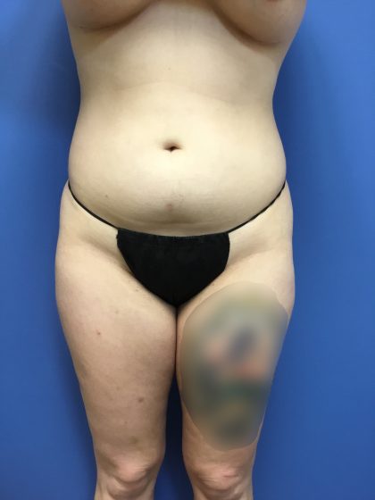 Liposuction Before & After Patient #2191