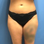Liposuction Before & After Patient #2191