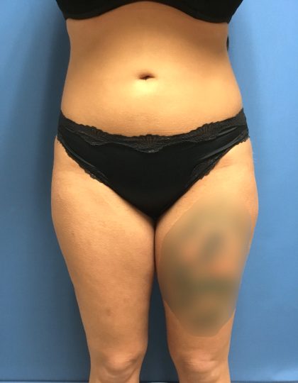 Liposuction Before & After Patient #2191