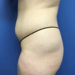 Liposuction Before & After Patient #2191